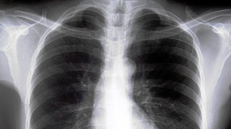 enfisema